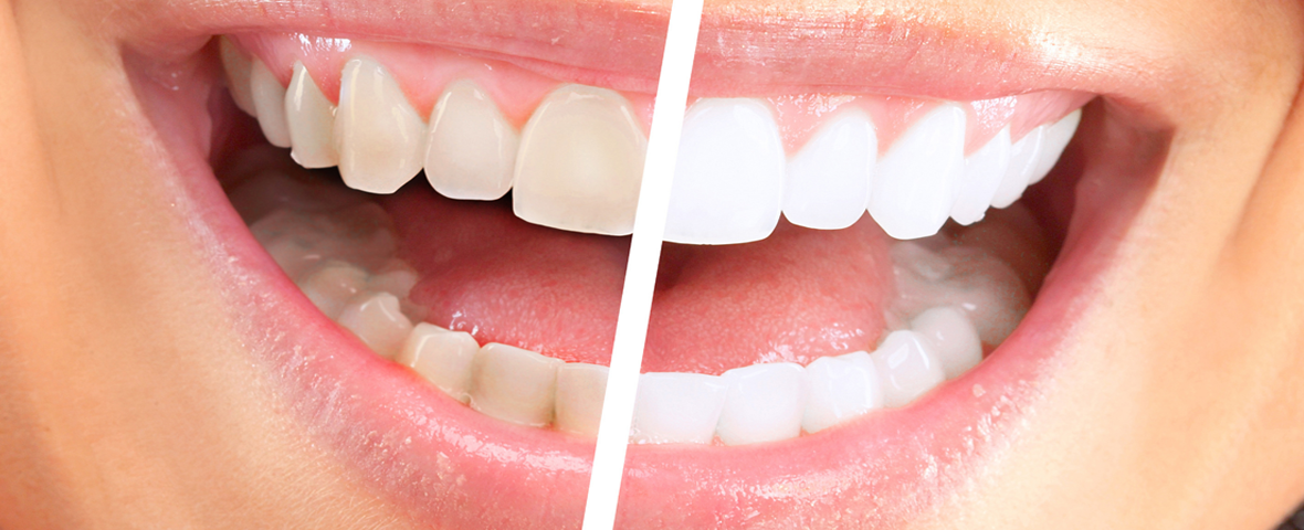 Teeth Whitening