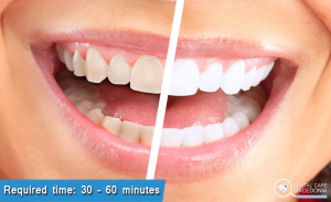 Teeth Whitening