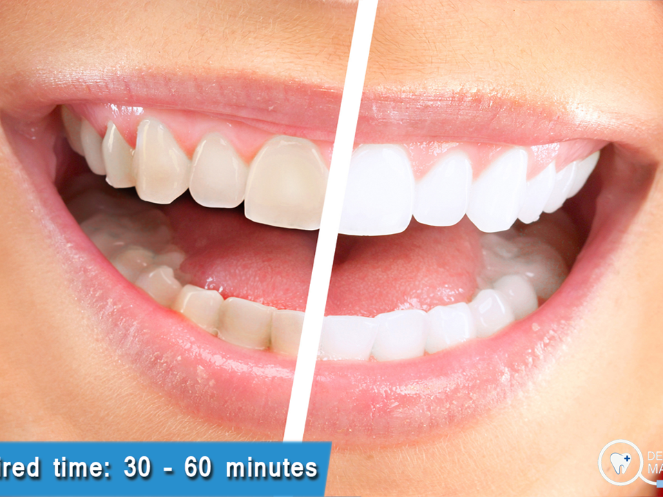 Teeth Whitening